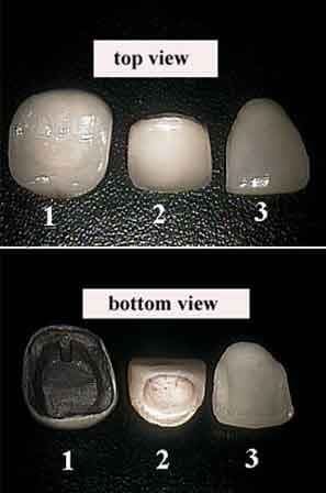Schema anatomique d'une facette dentaire collee sur la face vestibulaire d'une incisive