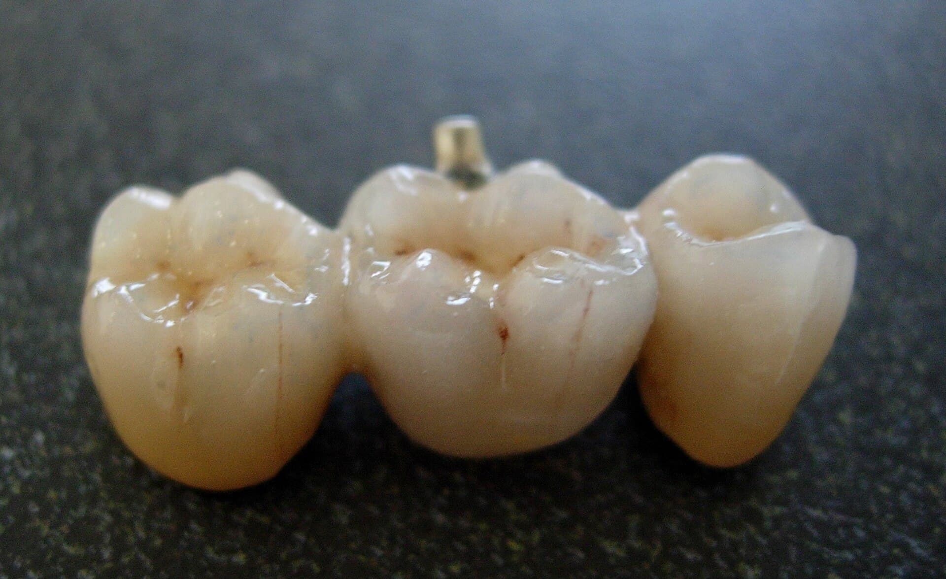 Facettes dentaires en porcelaine feldspathique : aspect translucide proche de l'email naturel
