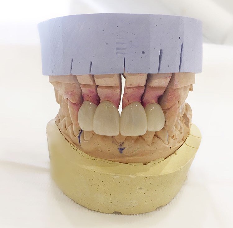 Laboratoire dentaire ou un ceramiste fabrique des facettes en porcelaine