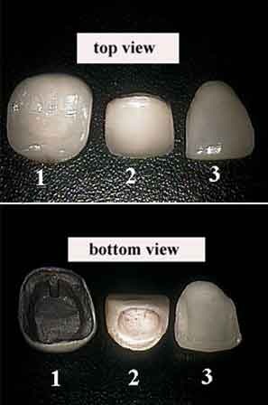 Schema anatomique d'une facette dentaire collee sur la face vestibulaire d'une incisive